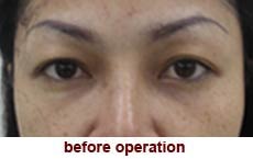 plastic-surgery-blepharoplasty